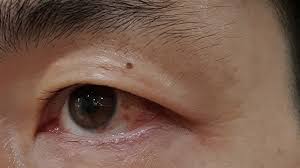 눈 실핏줄이 터지는 이유