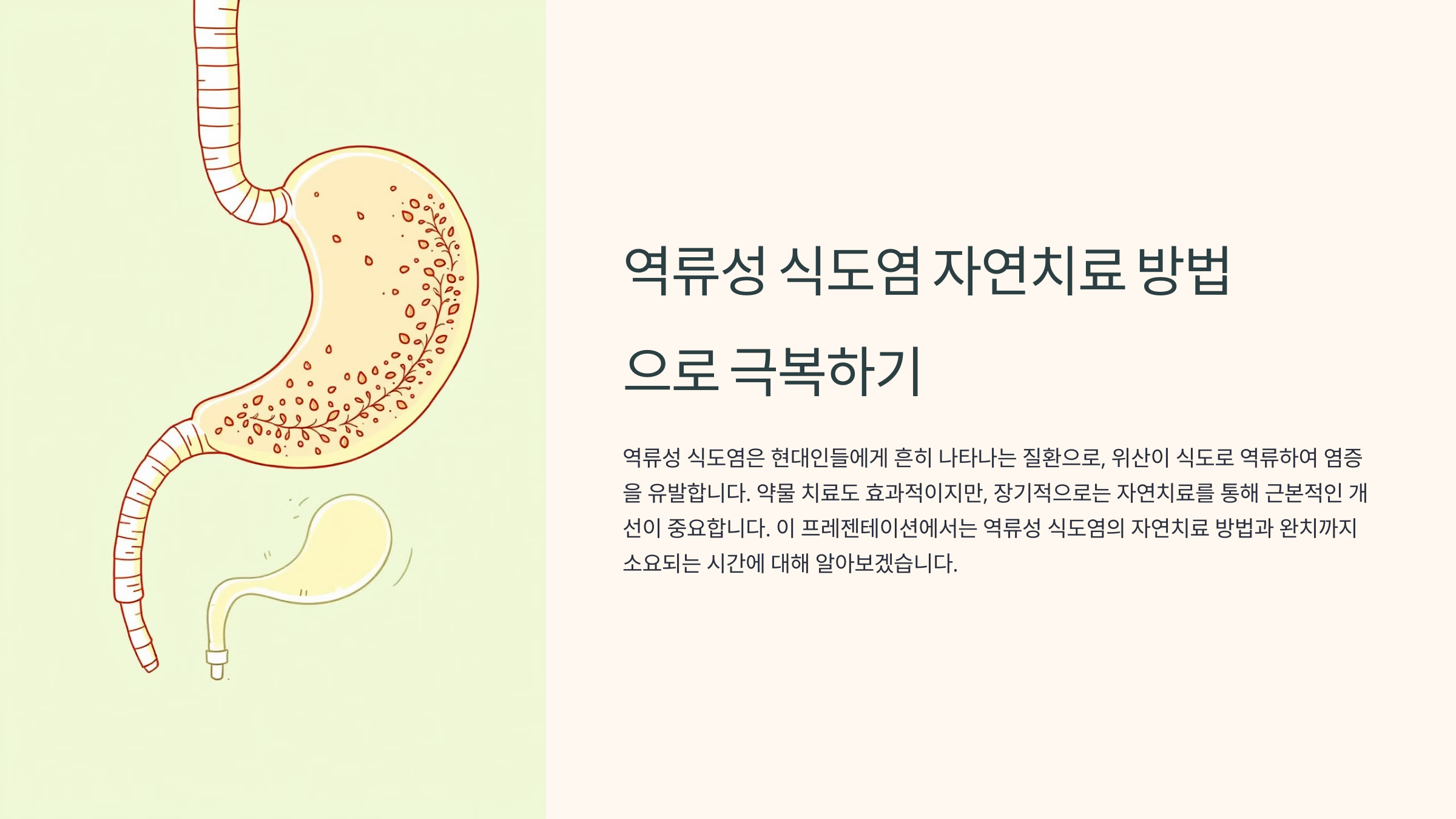 역류성 식도염