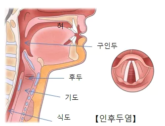 인후두염
