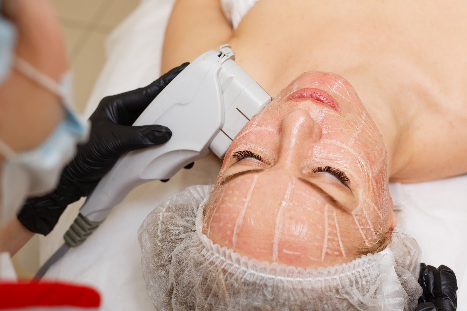 슈링크/울쎄라(초음파 리프팅) – 중안부 피부 탄력 개선