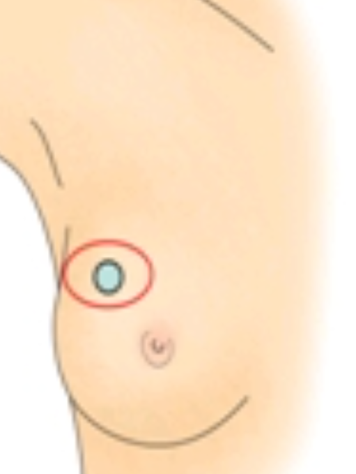 맘모톰 수술이란