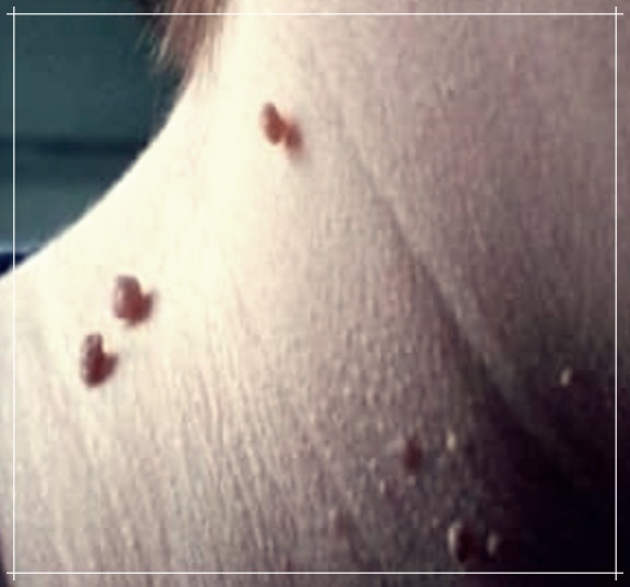 사타구니 쥐젖 치료비용에 대해 알아보기