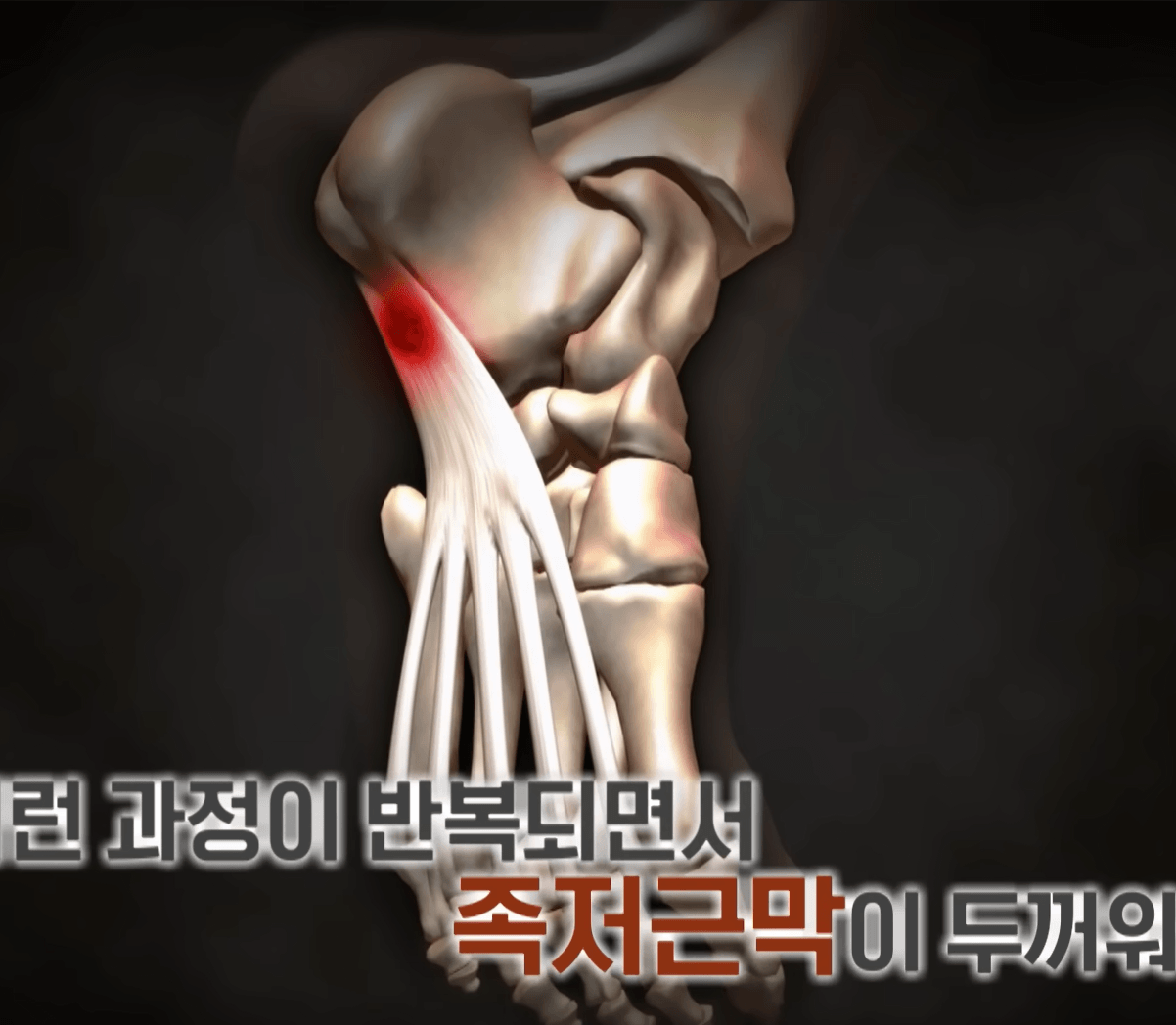 족저근막염