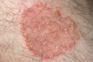 사타구니-습진-치료