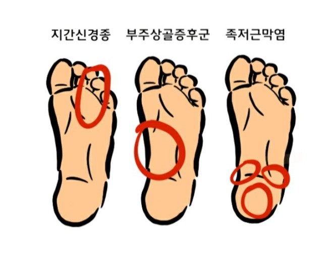 발바닥 부위별 통증