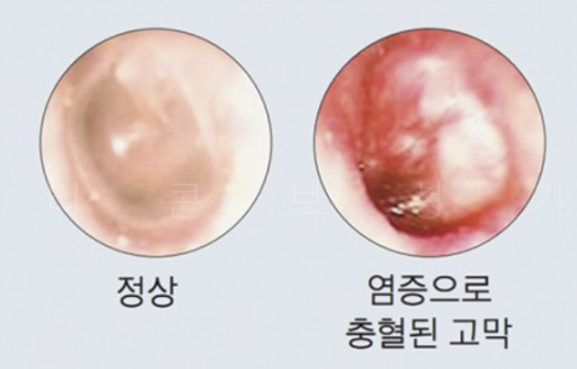 고막천공