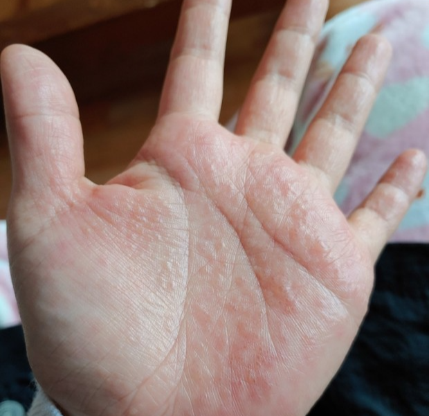 면역반응-유사성