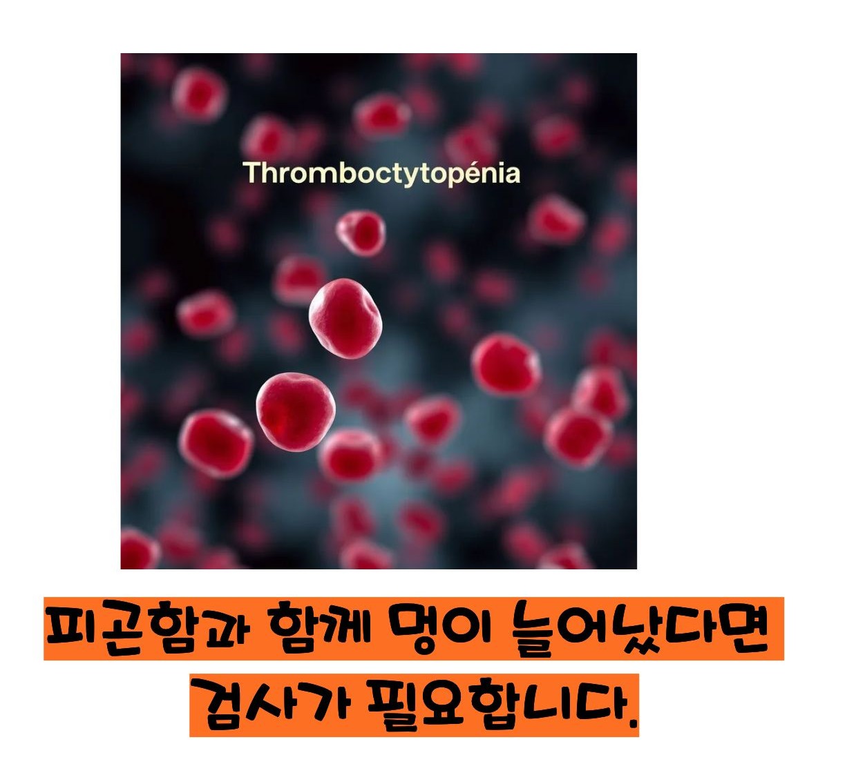 혈소판 감소증 증상