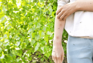 모기 물려서 빵빵 부었다