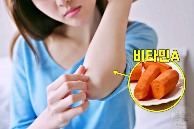 건성피부 관리,건성피부 가려움증,건성피부에 안 좋은 음식 비타민a