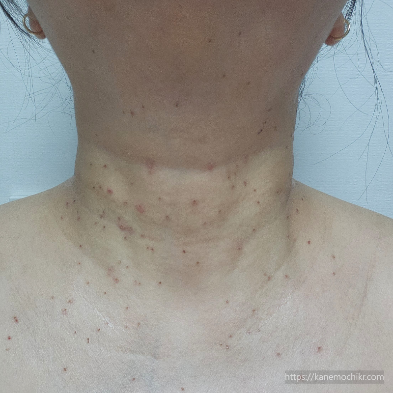 쥐젖-편평사마귀-제거-5일