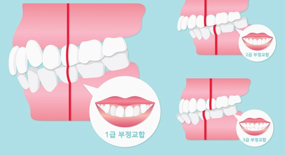 치아교정 급수 종류
