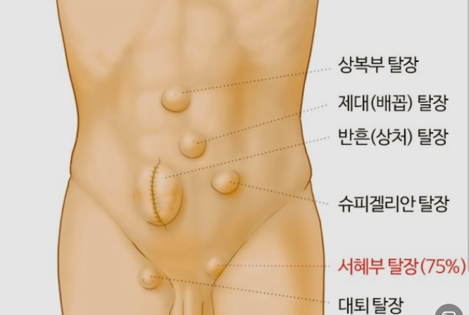 탈장-증세