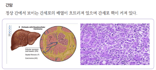 B형 간염 정의 특징 치료 예방