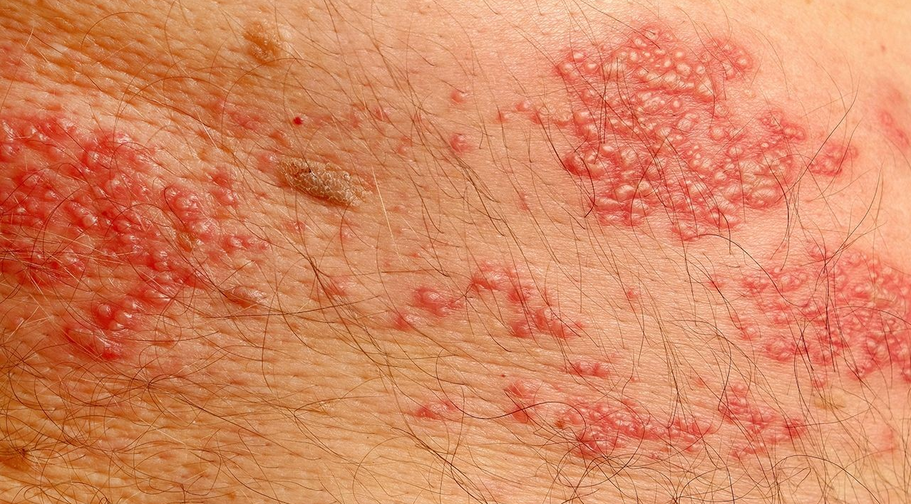 대상 포진의 주요 증상