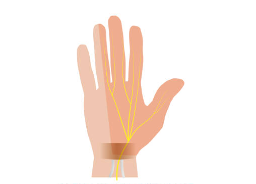 손목 터널 증후군