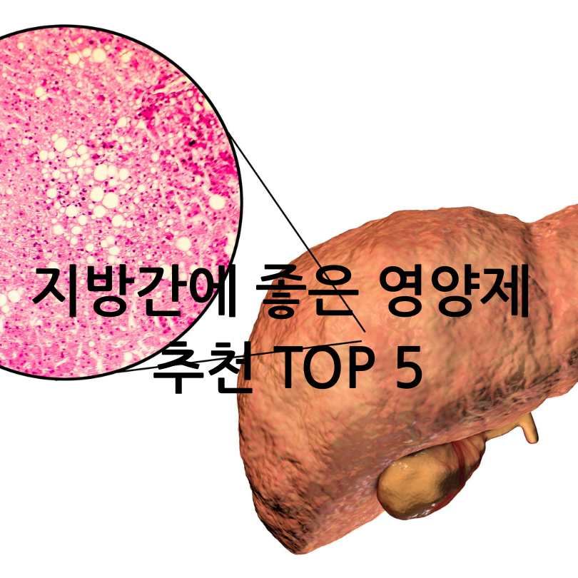 지방간에 좋은 영양제 추천 TOP 5