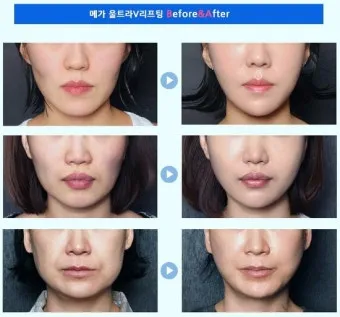 덴서티 리프팅 댄서티 가격 효과 유지기간에 관한 정보_2