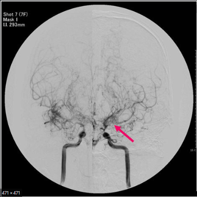 MRI 사진