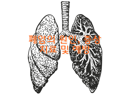 폐암의 원인, 증상, 치료 및 예방