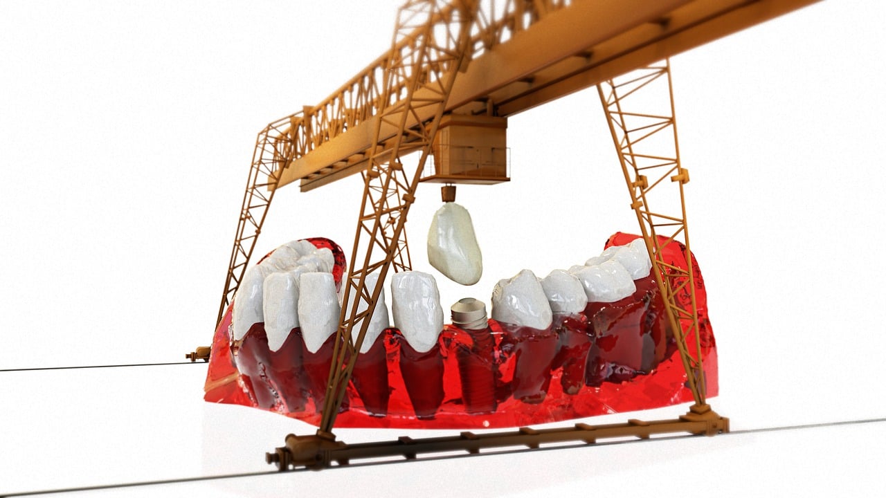 안성시-임플란트-치과-가격-비용-싼-곳,저렴한-곳,잘하는-곳,유명한-곳-BEST20-추천16