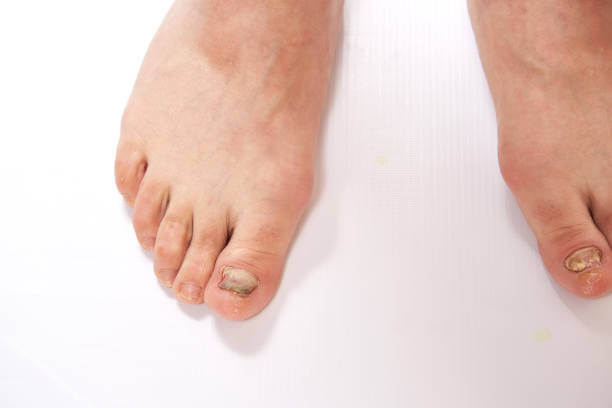 새끼발톱 갈라짐, 원인과 예방방법 때로는 작은 부위에 대한 관심 부족으로 인해 큰 문제가 발생할 수 있습니다. 이번 글에서는 새끼발톱이 갈라지는 이유와 예방 방법, 그리고 집에서 할 수 있는 치료 방법을 참고하시기 바랍니다. 이제부터 새끼발톱에 대한 지식을 쌓아 보세요.