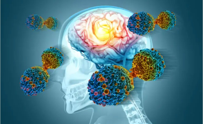 알츠하이머는 치매의 가장 흔한 원인