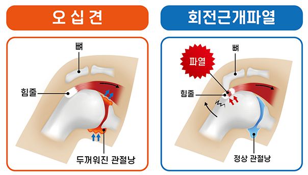 회전근개파열-오십견차이