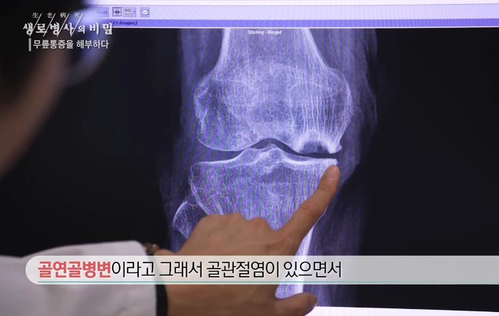 퇴행성-무릎-관절염-명의-박관규-교수