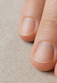 건선 피부염 완전정리