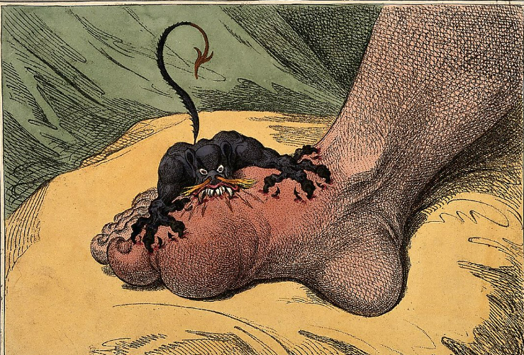 통풍 증상 - 열감