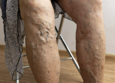 하지정맥류 증상 좋은운동 치료방법 총정리(최신)