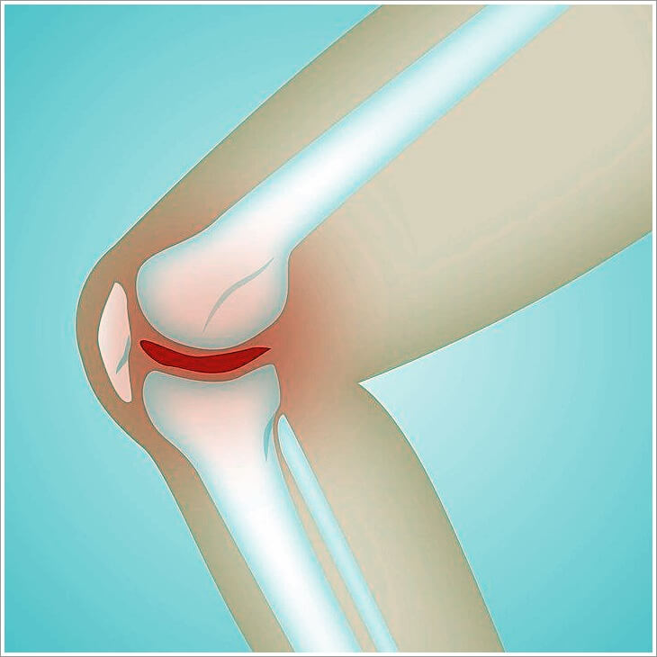 관절염 초기증상