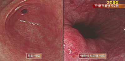 역류성 식도염 증상
