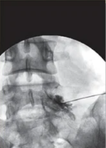 허리-디스크-신경차단술-방법-주의사항-가격-실비-보험