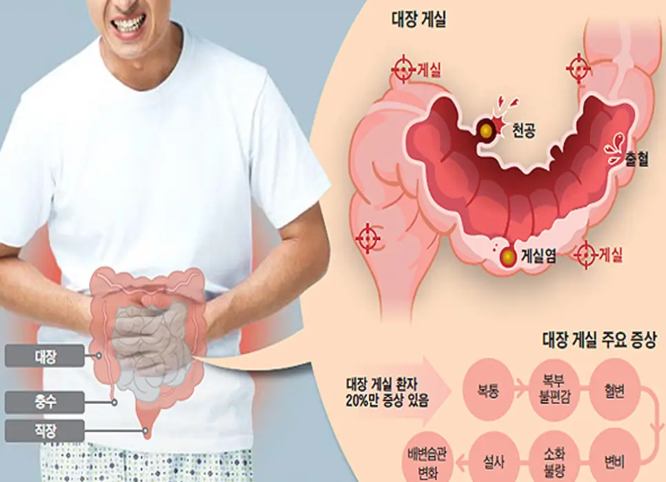 대장 게실염