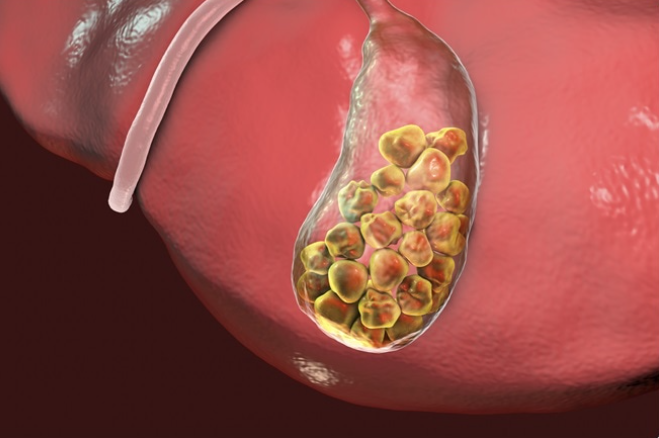 방광 결석 원인
