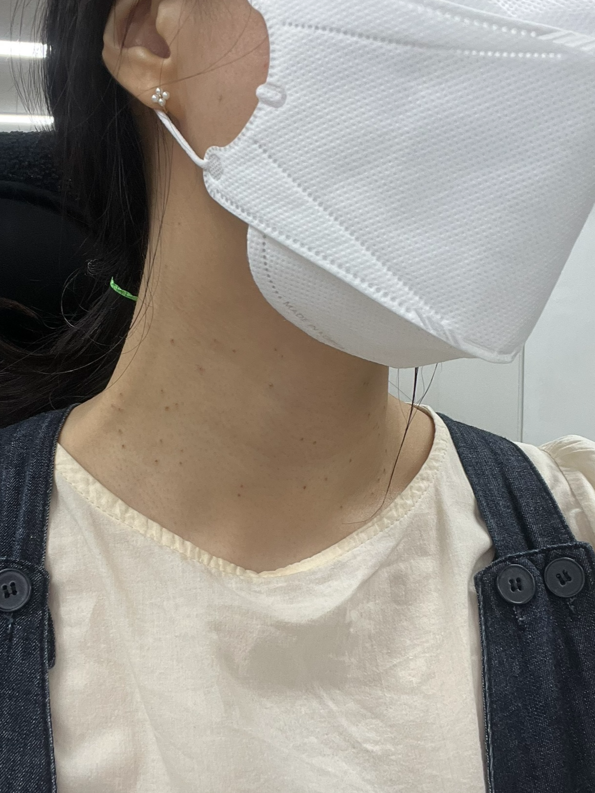 편평사마귀 레이저 제거 딱지 생김