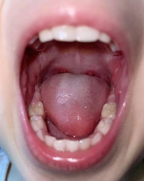 입안에 구내염이 생긴 모습