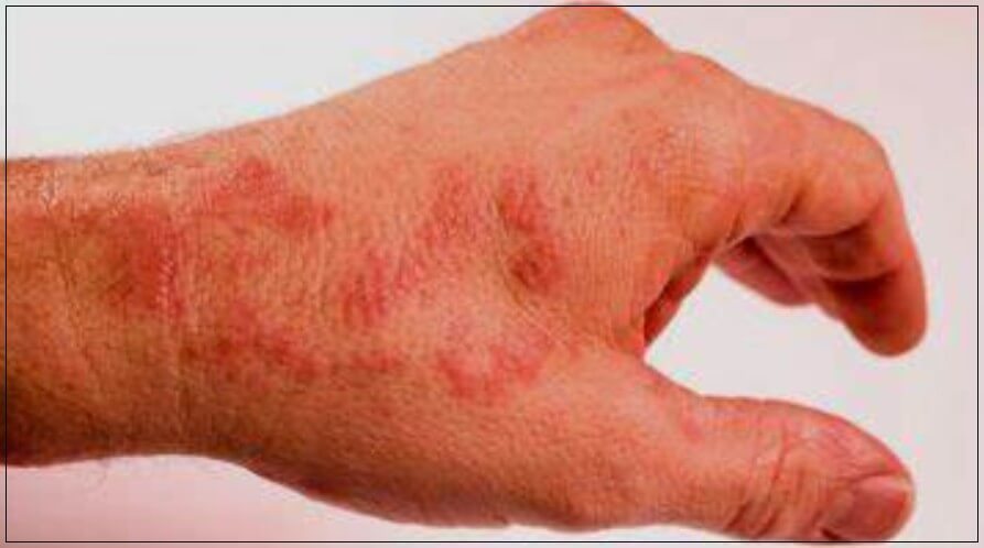 연쇄상구균독성쇼크증후군(STSS)