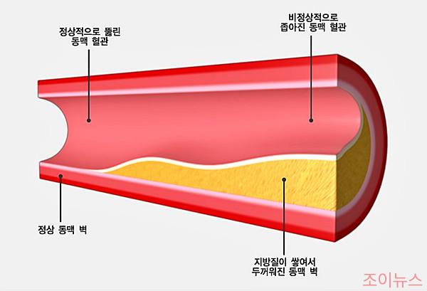 동맥경화증의 혈관 예시_출처: 국가건강정보포털