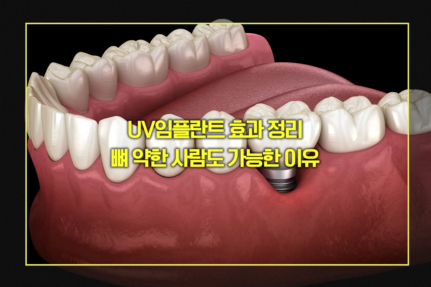 UV임플란트 효과