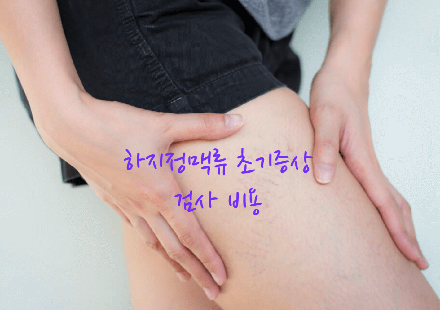 하지정맥류