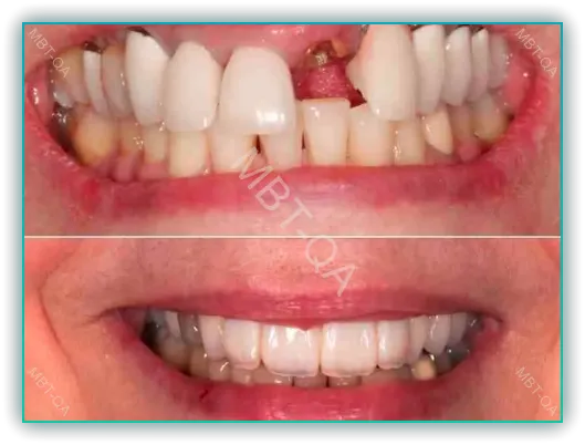 앞니 임플란트2