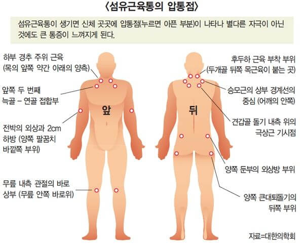 섬유근육통 증상