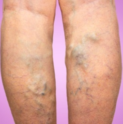 하지정맥류 치료방법과 수술비용, 운동 총정리