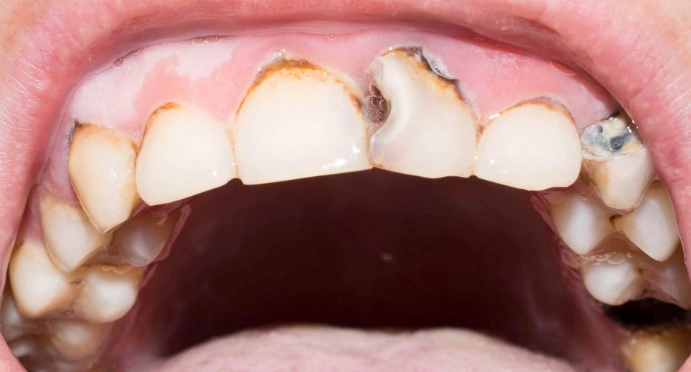 치아 우식증 예방법 10가지