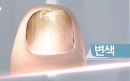 발톱 무좀 없애는 방법