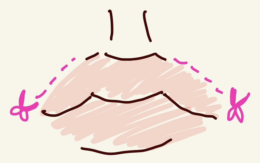 인중 축소 수술 후기