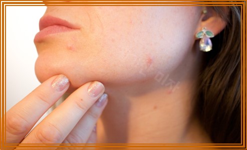 임신중 피부 트러블 이유 6가지